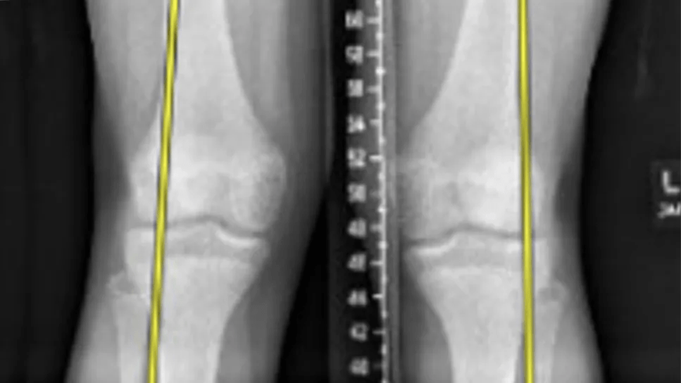 X-ray of patient with knock knees