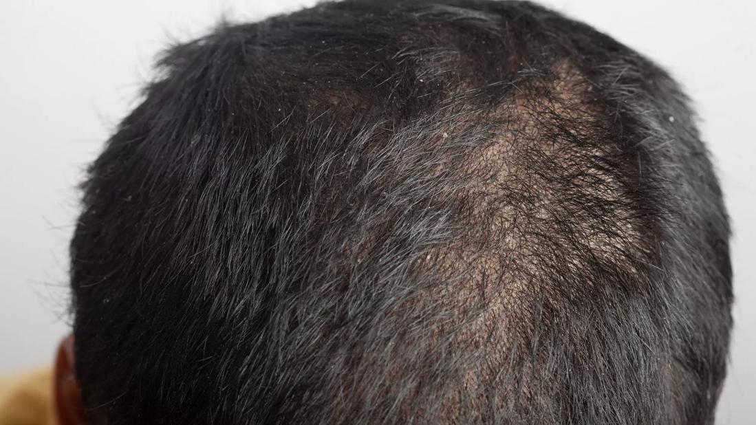 Closeup of a head with scalp psoriasis