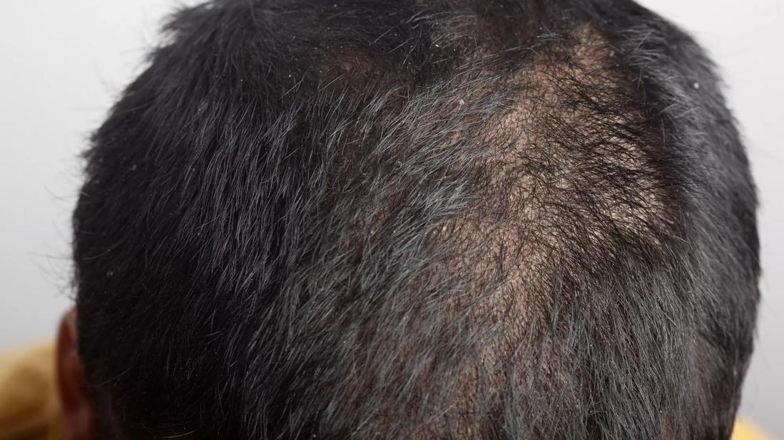 Closeup of a head with scalp psoriasis