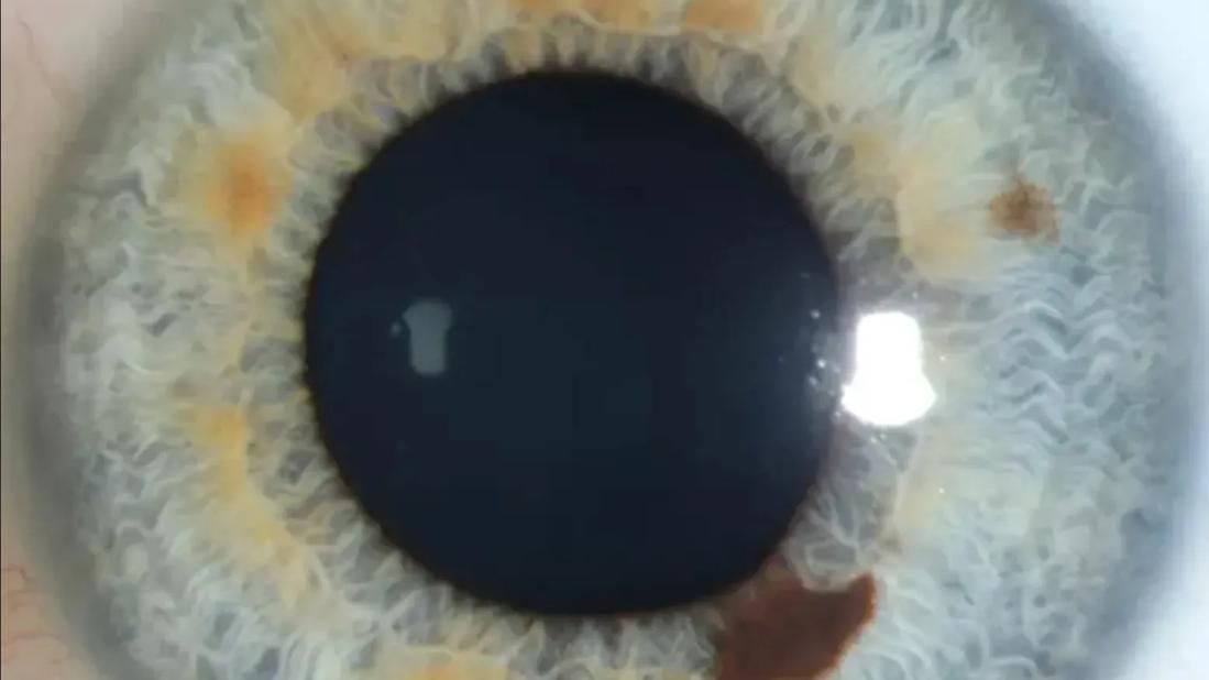 Eye with a lesion on the iris