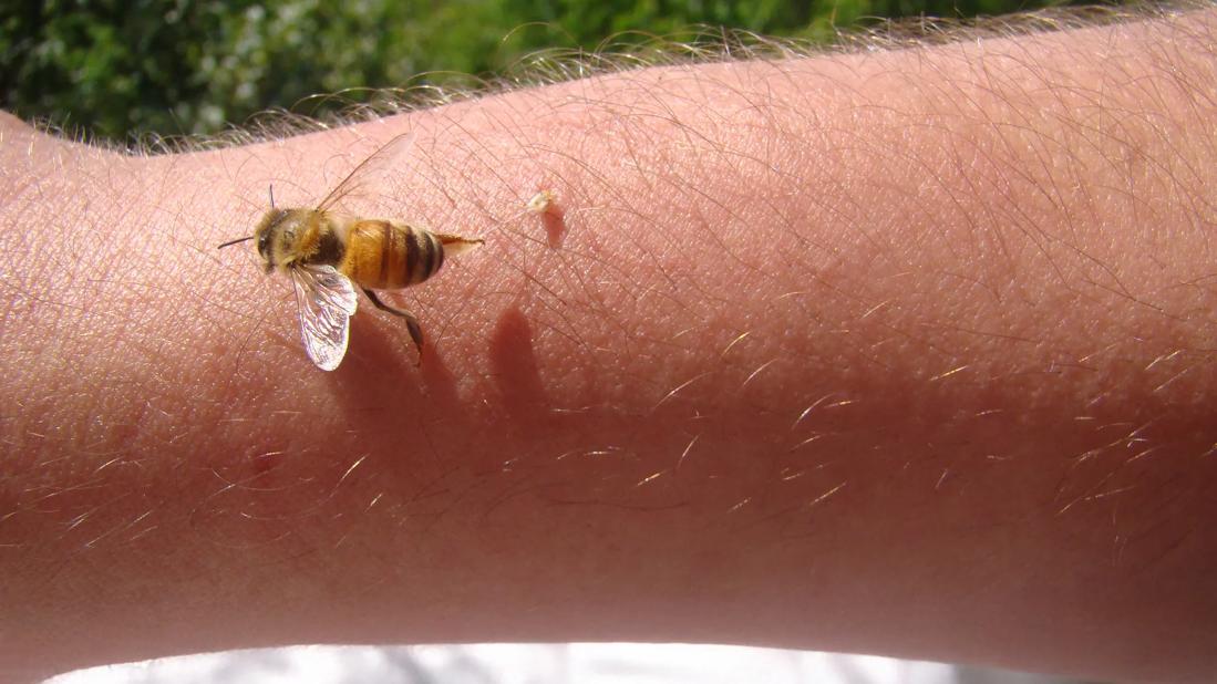 A bee on an arm, with its stinger stuck in the arm