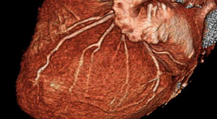 CT_Angiography-690&#215;380