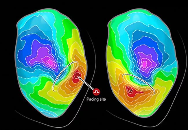 20-HVI-1886651-ablation-mapping-650&#215;450