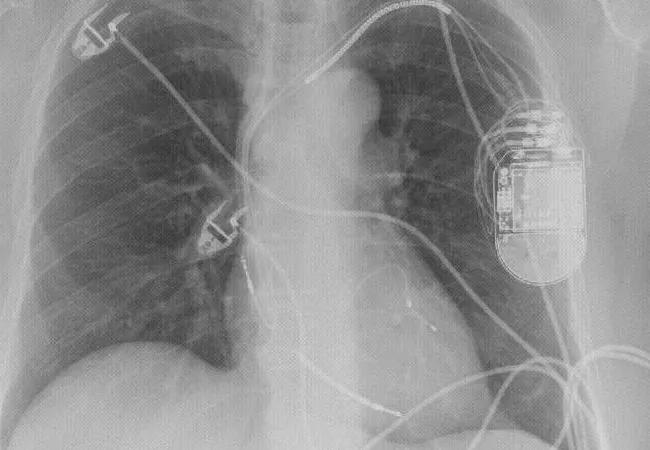 20-HVI-2013163_cardiac-resynchronization-therapy_650x450