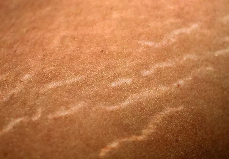 A close-up of stretch marks on someone's skin