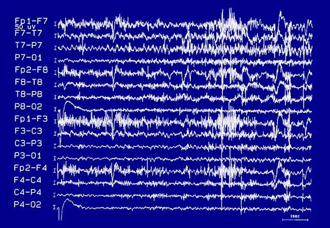 Differentiating Sleep-Related Seizures From NREM Arousal Disorders