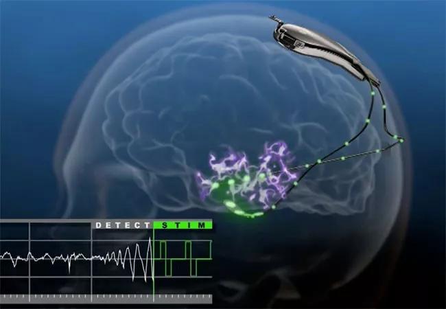 19-NEU-320-RNS-neurostimulation-650&#215;450