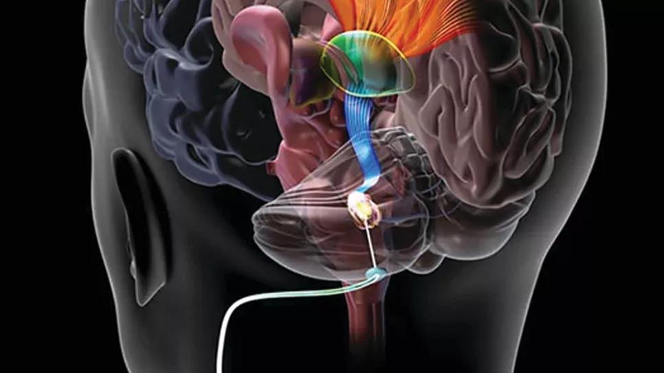 deep brain stimulation of dentate nucleus