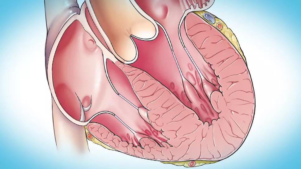 heart showing obstructive cardiomyopathy