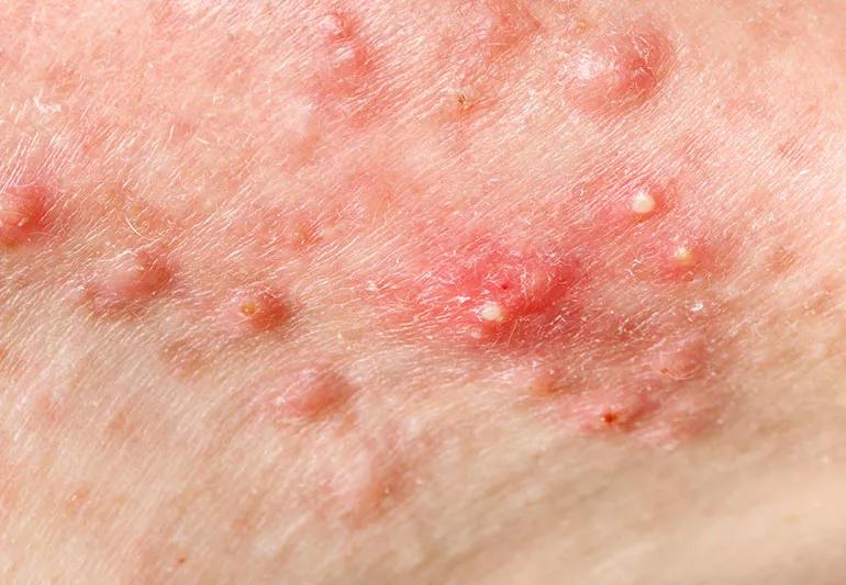 A close up image of red and white pimples on the skin