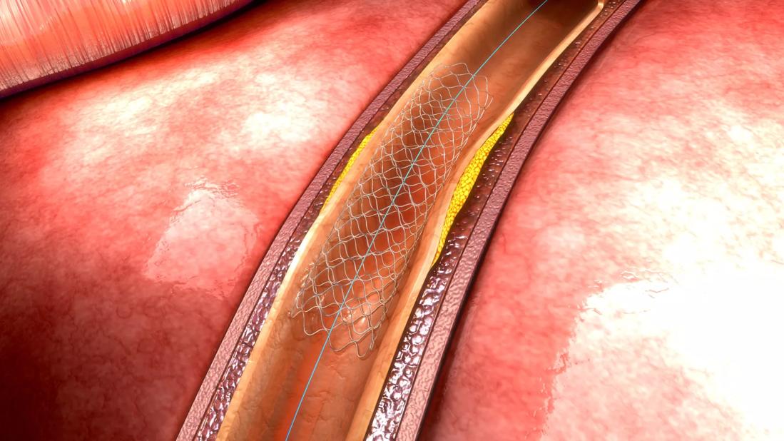 flared balloon-expandable stent in superior mesenteric artery