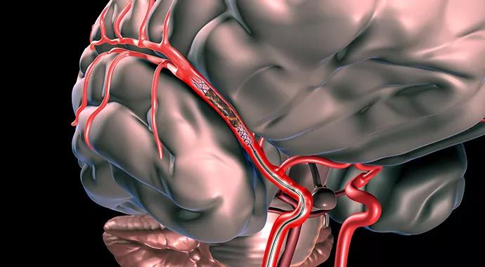 690&#215;380-Interventional-Stroke