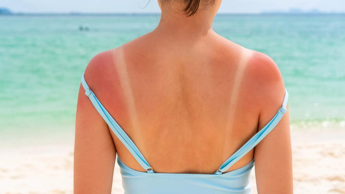 A person at the beach with sunburnt shoulders and pale lines where the bathing suit straps were