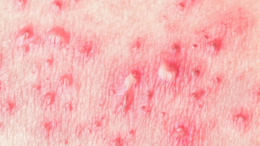 How You Can Avoid Shingles If You Have Cancer