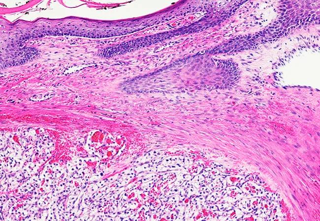 650&#215;450-renal-cell-carcinoma