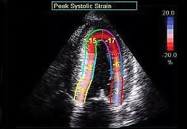 19-HRT-5577-cardiac-amyloidosis-imaging-650&#215;450