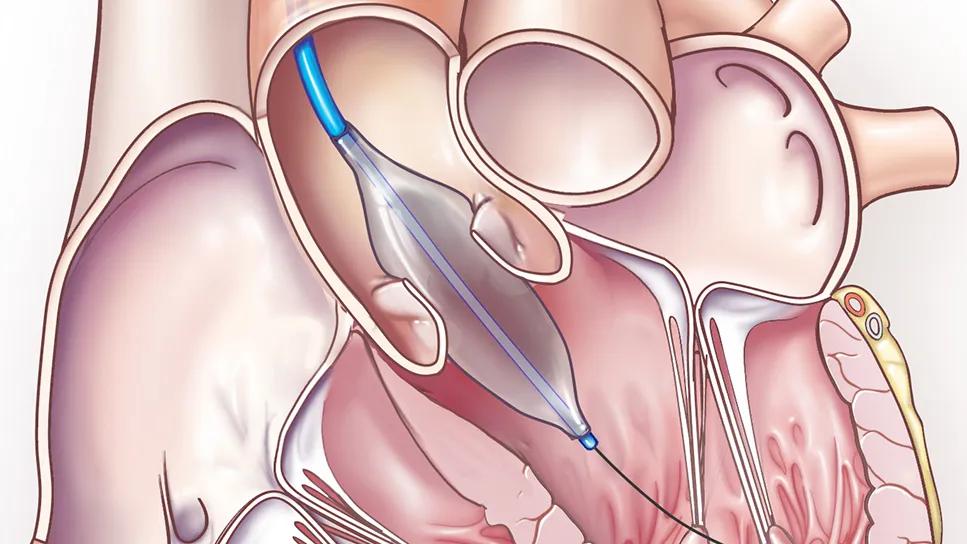 deployment of balloon aortic valvuloplasty device in the heart