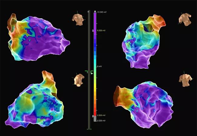 maps for ventricular tachycardia ablation