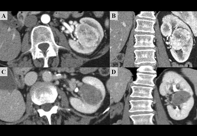 Neoadjuvant Therapy For Renal Masses in a Solitary Kidney