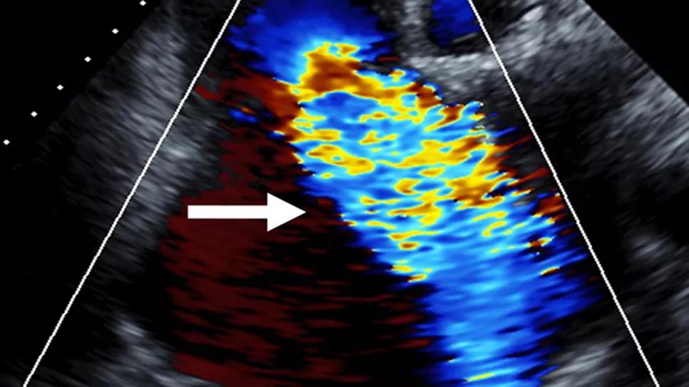 severe tricuspid regurgitation on an echocardiogram