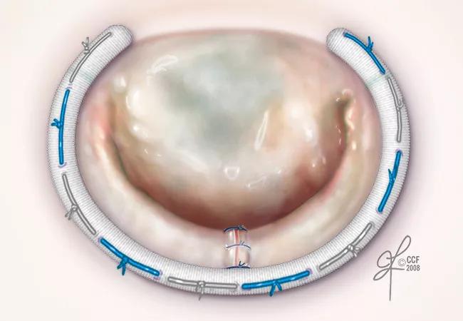 Mitral Valve Repair