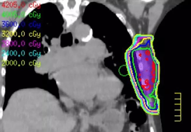 650x450_Chest-Wall-Sarcoma