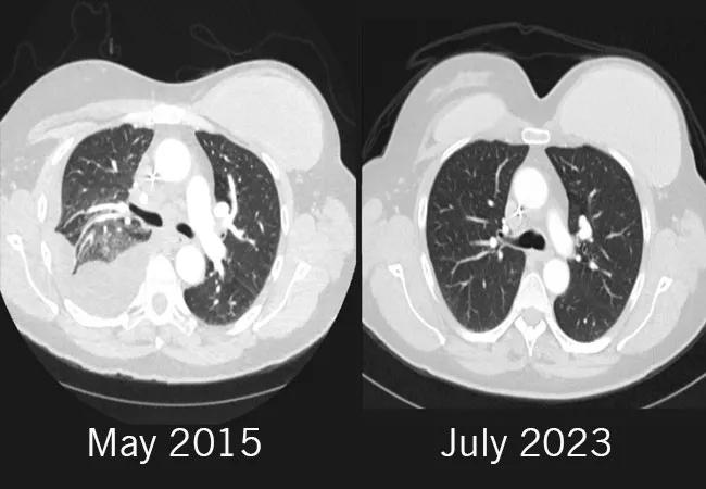 23-CNR-4071967-CQD-Hero-650&#215;450 scan for triple-negative breast cancer case study