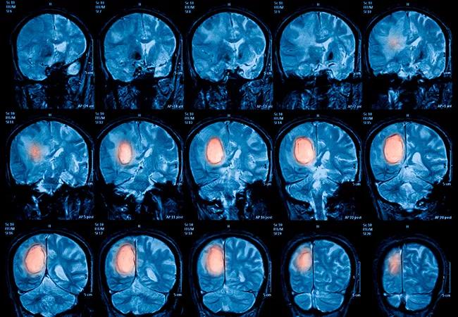 Magnetic resonance imaging (MRI) of the brain, brain tumor