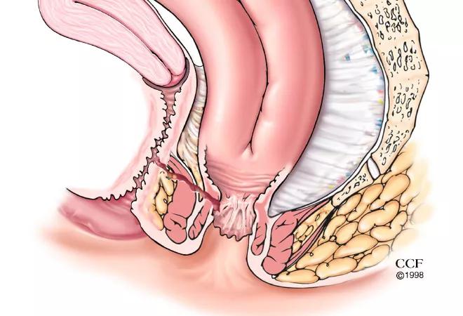 17-DDI-009-Pouch-Vag-Fistula-CQD