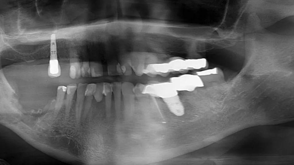 Imaging of Stage IV (“borderline”) preoperative panorex