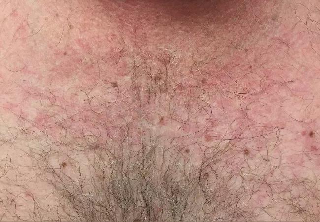 Mosaicism and TNFR-Associated Periodic Syndrome (TRAPS)