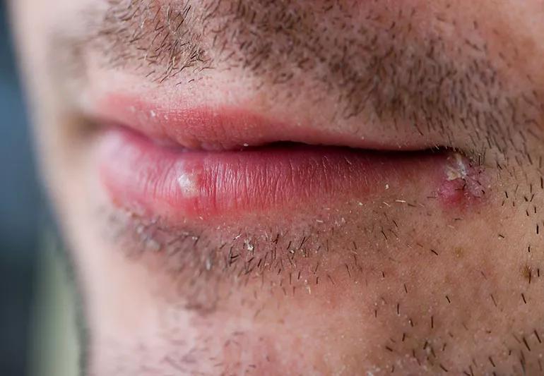 A close-up of cold sores on someone's mouth.
