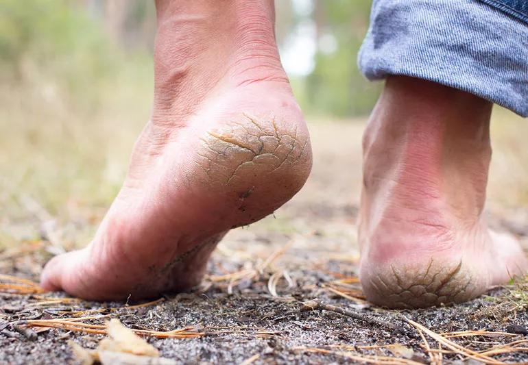 cracked heels of person in field