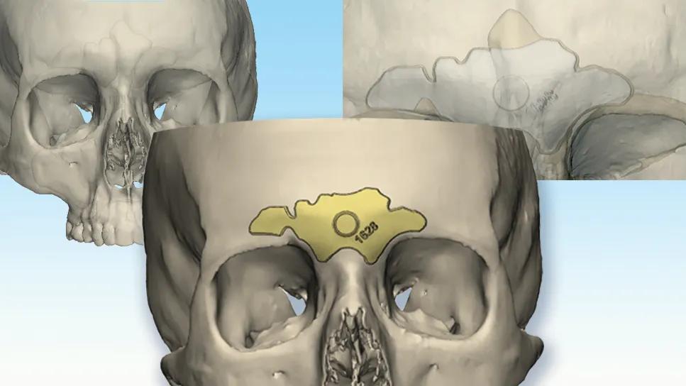 skull indicating area on brow for surgical sculpting