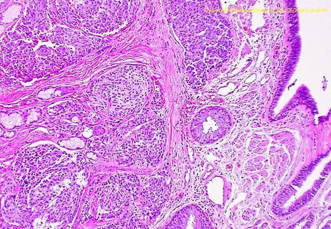 PrimaryPulmonaryCarcinoid