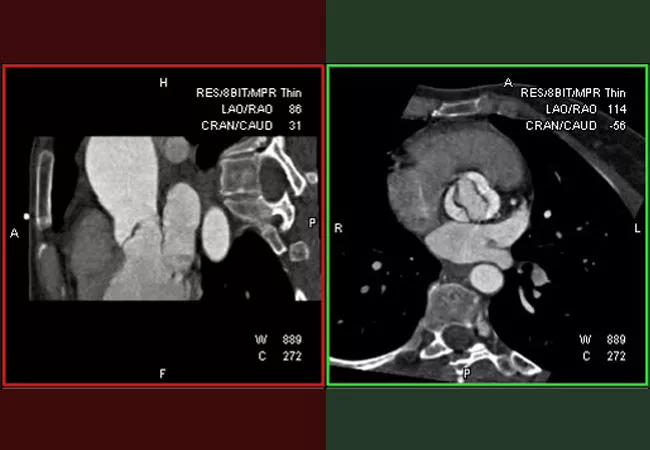 19-HRT-171-bicuspid-aortic-valve-650&#215;450