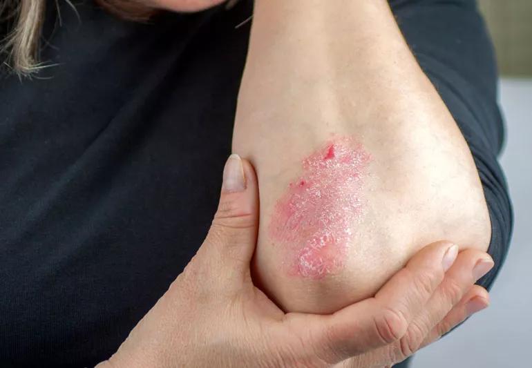 Person has a stress outbreak of psoriasis on thier elbow.