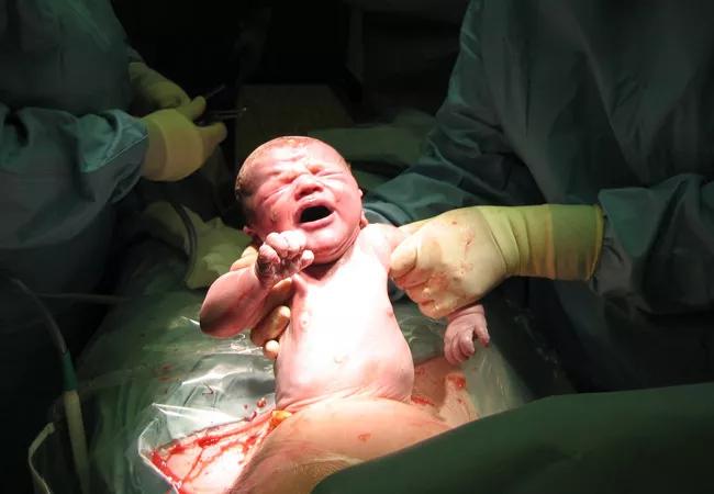 Cesarean-delivery_650x450