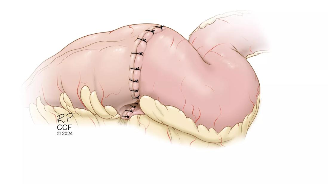 Medical illustration of Ileocolic Resection