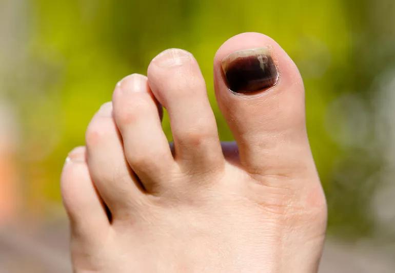 black toenail from running