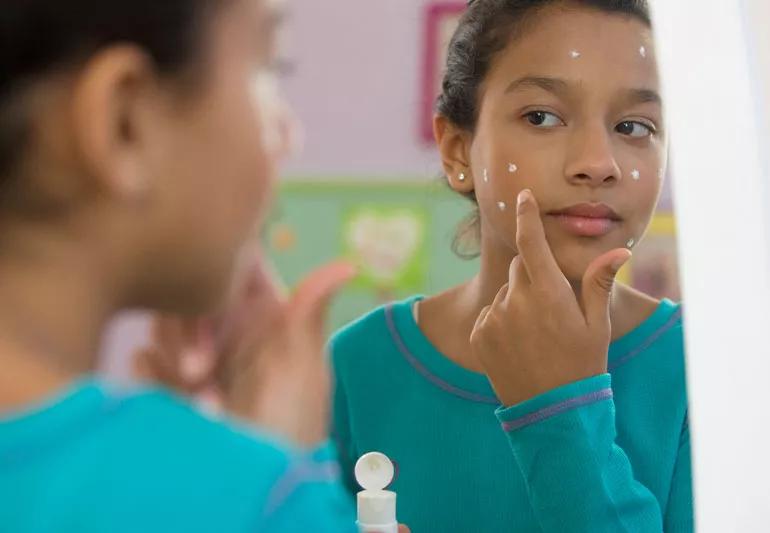 girl applying acne medication to face