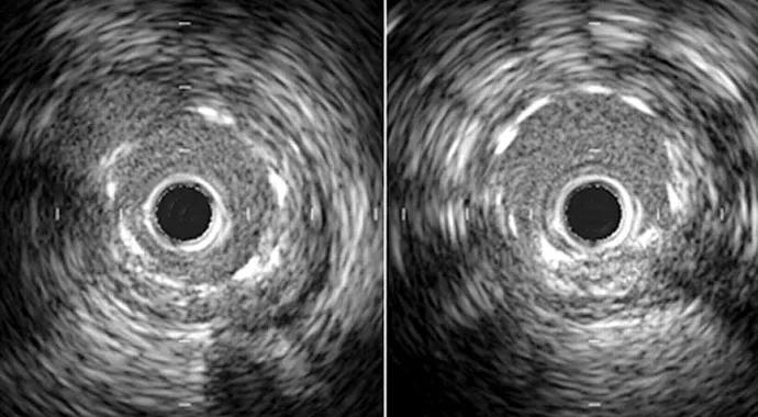 IVUS-690&#215;380