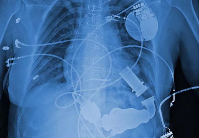 In LVAD Patients with Atrial Arrhythmias, Rhythm Control Offers Little Benefit