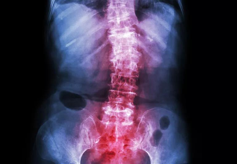 Adult X-ray showing scoliosis