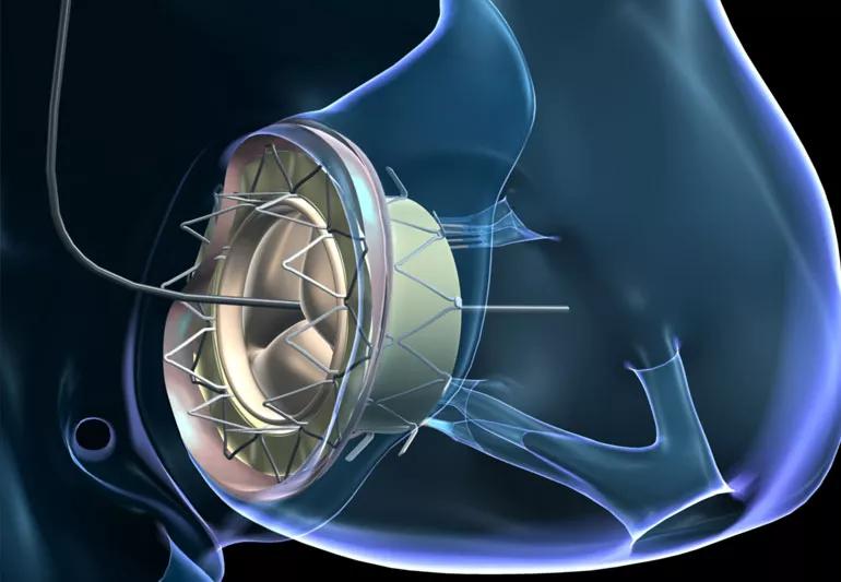 Tricatherter Valved stent in use - illustration