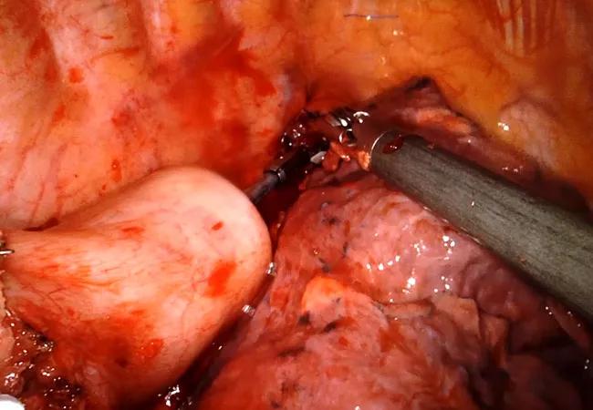 Image of Note: Using Robotics to Expand Esophagectomy Options