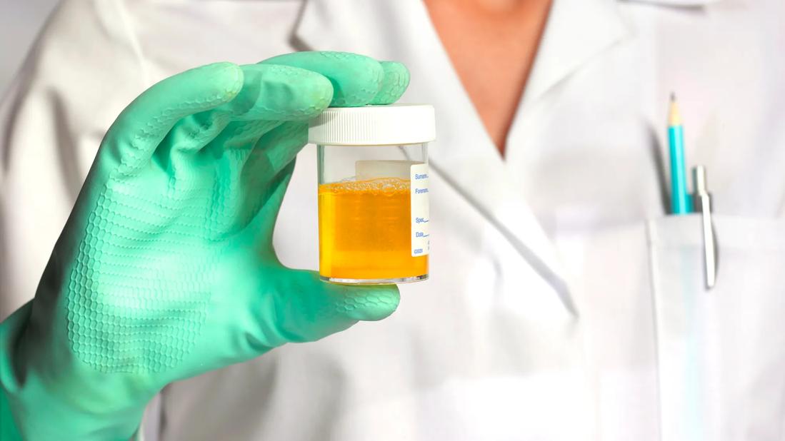 Clinician holding urine sample in gloved hand