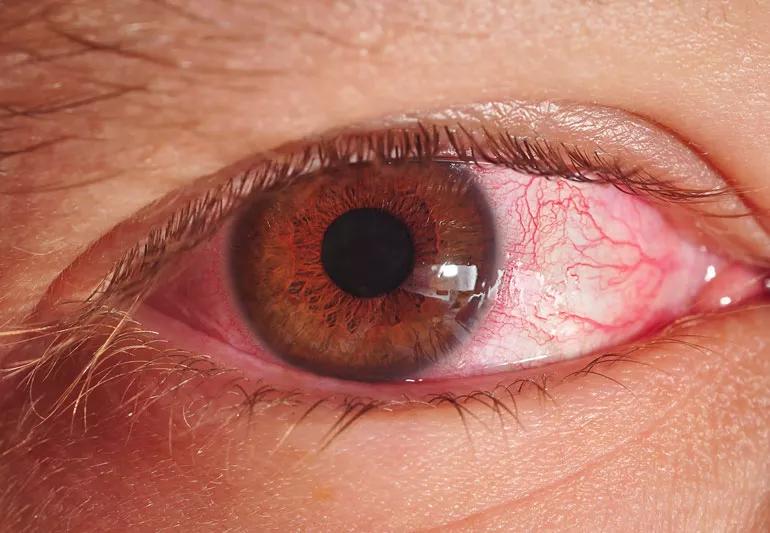 pink eye infection