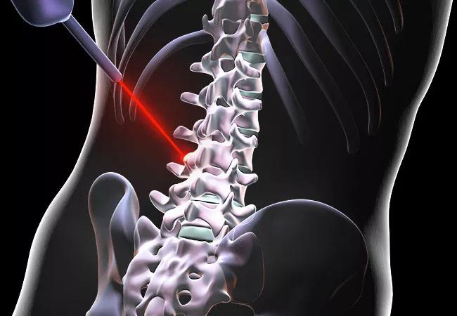 Can Laser Spine Surgery Fix Your Back Pain?
