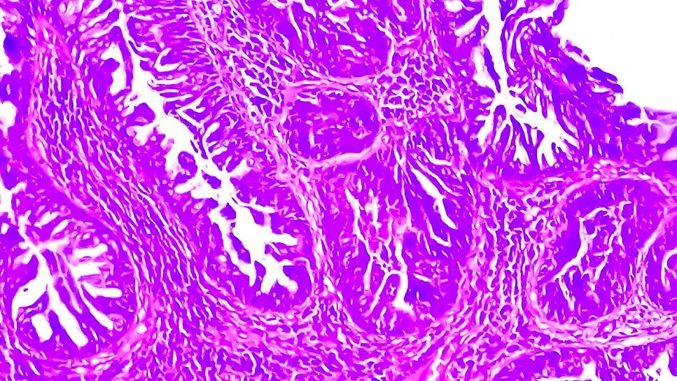 Squamous cell carcinoma
